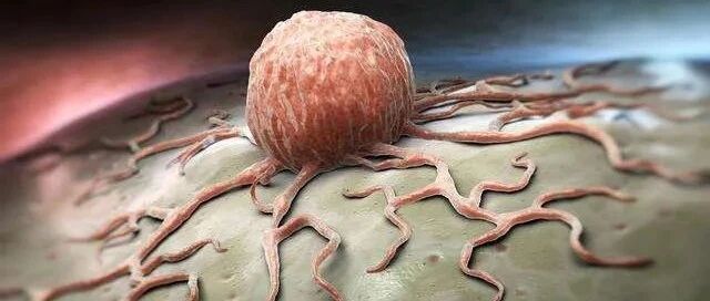 囊肿和肿瘤，有什么区别？会不会癌变？出现在3个部位，真的要警惕