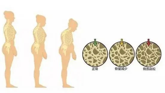 警惕！這七個壞習慣導致骨質疏松！ 健康 第3張