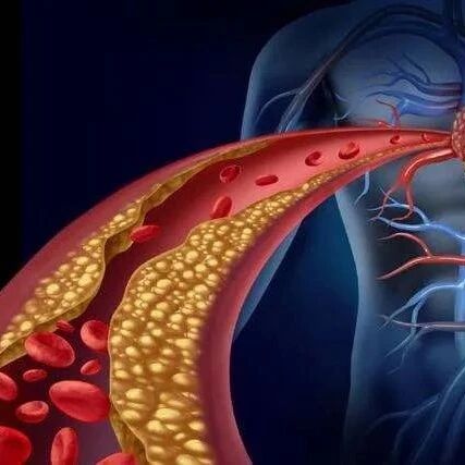 高血脂：最隐蔽的“杀手”，警惕皮肤5大求救信号！