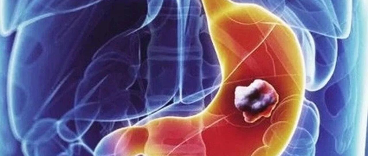 早期胃癌有迹可寻！三个小症状早已提醒您，很多人却忽视了！