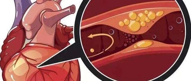 每年12月和1月是“心梗爆发期”！8个意想不到的前兆，知道能救命