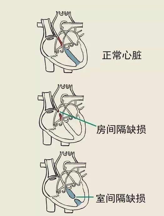 科普漫畫丨什麼是先天性心臟病？ 親子 第19張