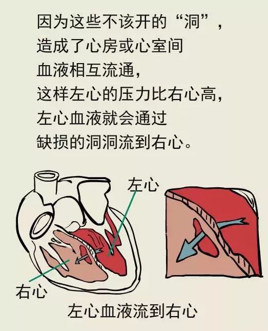 科普漫畫丨什麼是先天性心臟病？ 親子 第22張