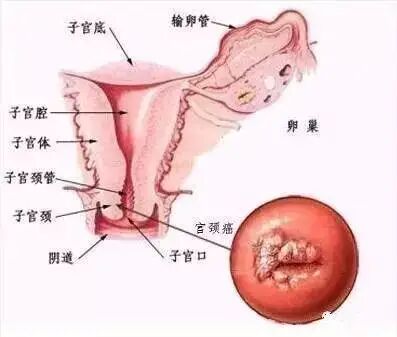 宫颈癌是什么