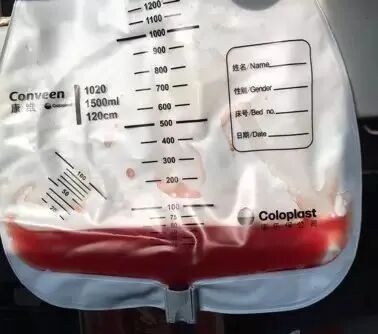 为什么新尿袋会漏尿尿管周围漏尿怎么办？关于尿管常见的七个问题，看看你知道多少？_https://www.jmylbn.com_新闻资讯_第4张