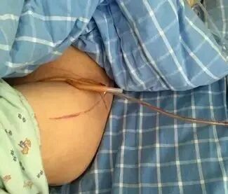 为什么新尿袋会漏尿尿管周围漏尿怎么办？关于尿管常见的七个问题，看看你知道多少？_https://www.jmylbn.com_新闻资讯_第2张