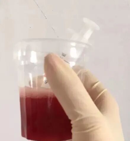 为什么新尿袋会漏尿尿管周围漏尿怎么办？关于尿管常见的七个问题，看看你知道多少？_https://www.jmylbn.com_新闻资讯_第6张