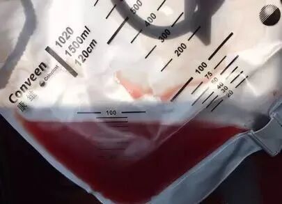 为什么新尿袋会漏尿尿管周围漏尿怎么办？关于尿管常见的七个问题，看看你知道多少？_https://www.jmylbn.com_新闻资讯_第5张