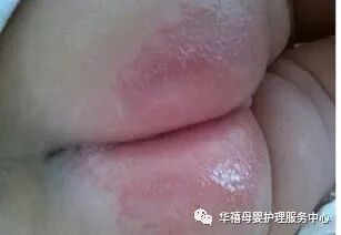 炎炎夏日 宝宝得了尿布疹怎么办 华禧母婴护理服务中心 微信公众号文章阅读 Wemp