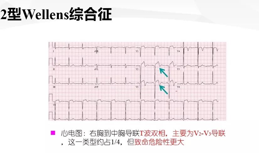 一文詳解：急性心肌梗死的判讀！ 健康 第42張