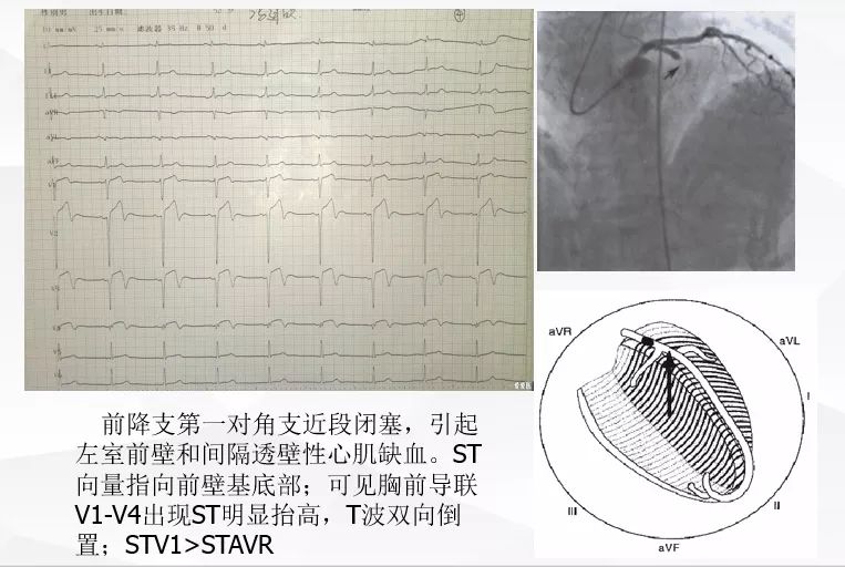 一文詳解：急性心肌梗死的判讀！ 未分類 第30張