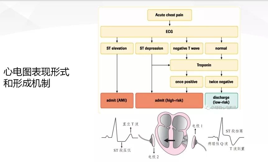 一文詳解：急性心肌梗死的判讀！ 未分類 第18張