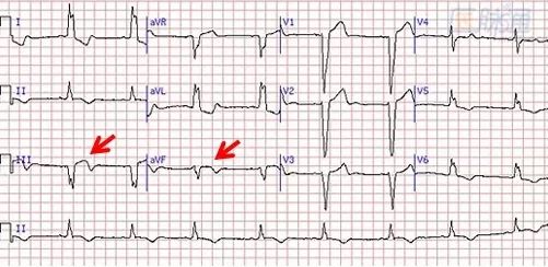 一文詳解：急性心肌梗死的判讀！ 未分類 第36張
