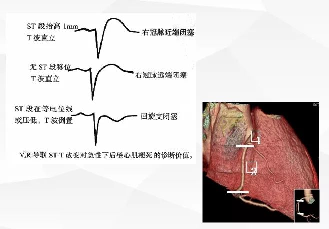 一文詳解：急性心肌梗死的判讀！ 健康 第33張