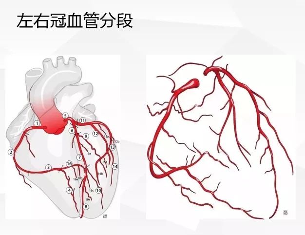 一文詳解：急性心肌梗死的判讀！ 未分類 第14張