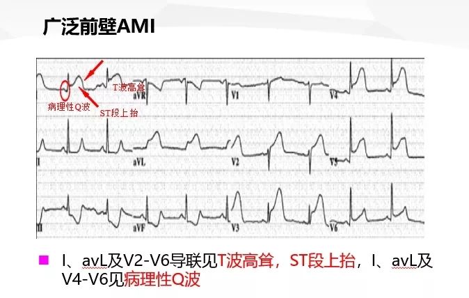 一文詳解：急性心肌梗死的判讀！ 未分類 第29張