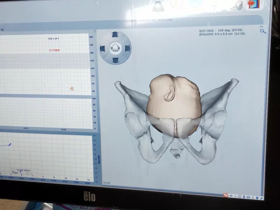 产程三维导航是什么分娩有导航，顺产不慌张 ｜ 张店区妇幼保健院护产神器LaborPro为准妈妈们保驾护航_https://www.jmylbn.com_新闻资讯_第5张