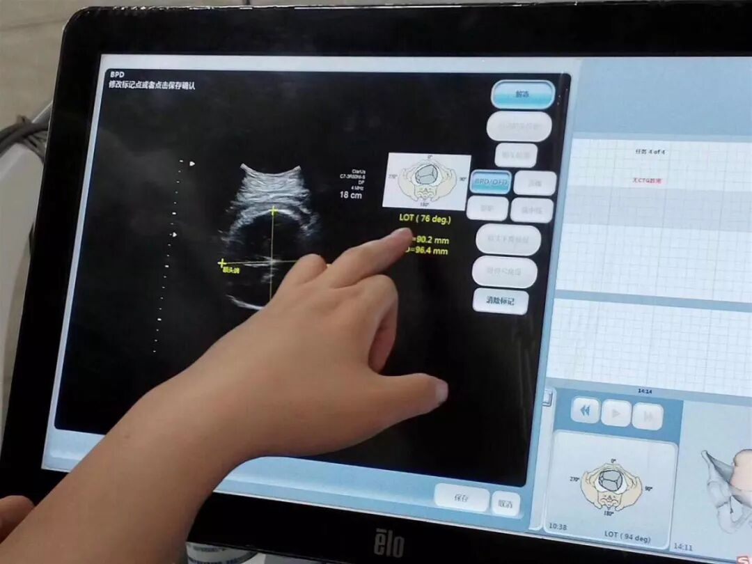 产程三维导航是什么分娩有导航，顺产不慌张 ｜ 张店区妇幼保健院护产神器LaborPro为准妈妈们保驾护航_https://www.jmylbn.com_新闻资讯_第6张