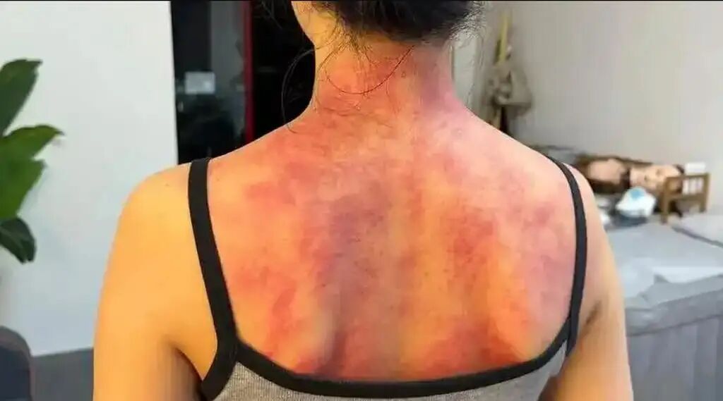 Ancient TCM Dampness Remedies Beat Summer Heat for Chinese Youth