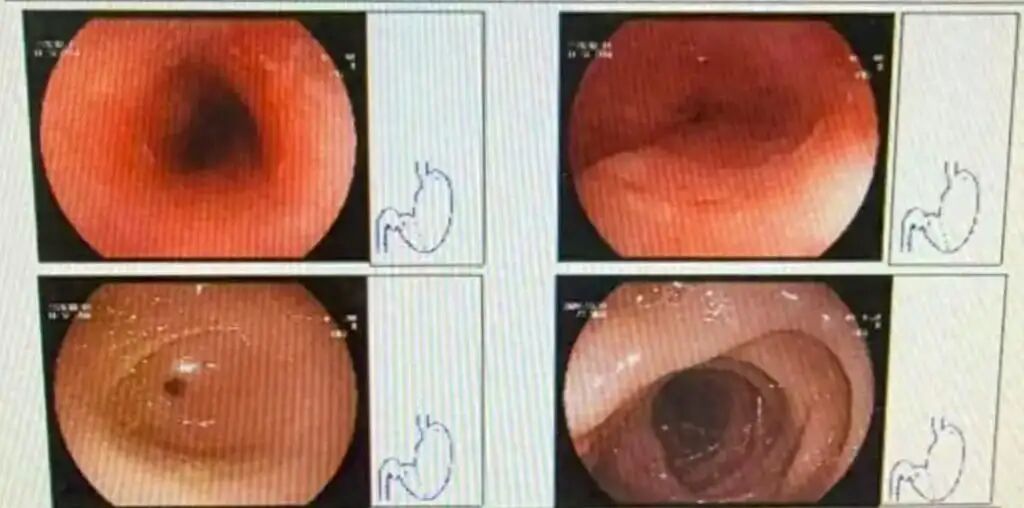 An endoscopy examination photograph shows the extent of the damage done to Wang. Photo: Sina