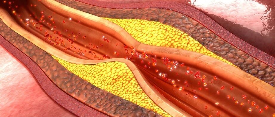 免疫治疗副作用又有新花样: 不可小视的动脉粥样硬化, 应该怎样预防？