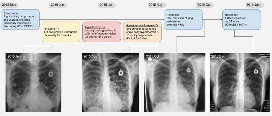 双免疫治疗联合“高效且高毒”, 这样使用副作用大幅降低