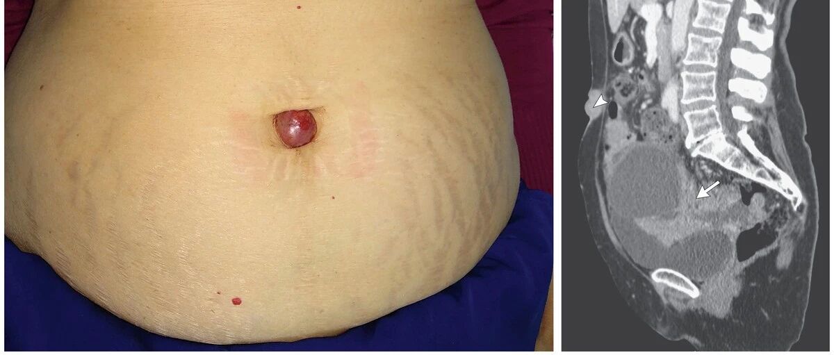 口腔溃疡, 肚脐长“球”, 背上花斑, 这些都可能是癌症的表现