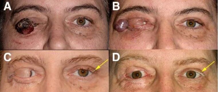 PD-1的奇葩副作用：有的惊喜，有的惊吓