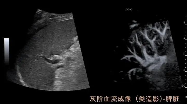 彩超logiq怎么读【重磅消息】更清晰！更高效！更多功能！我院引进GE LOGIQ-Fortis Plus彩超设备_https://www.jmylbn.com_新闻资讯_第7张