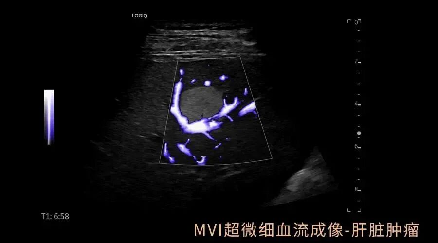 彩超logiq怎么读【重磅消息】更清晰！更高效！更多功能！我院引进GE LOGIQ-Fortis Plus彩超设备_https://www.jmylbn.com_新闻资讯_第4张