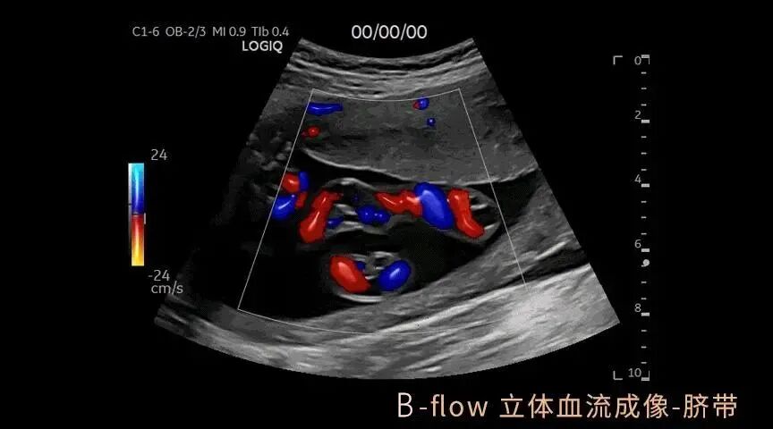 彩超logiq怎么读【重磅消息】更清晰！更高效！更多功能！我院引进GE LOGIQ-Fortis Plus彩超设备_https://www.jmylbn.com_新闻资讯_第6张