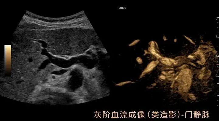 彩超logiq怎么读【重磅消息】更清晰！更高效！更多功能！我院引进GE LOGIQ-Fortis Plus彩超设备_https://www.jmylbn.com_新闻资讯_第8张