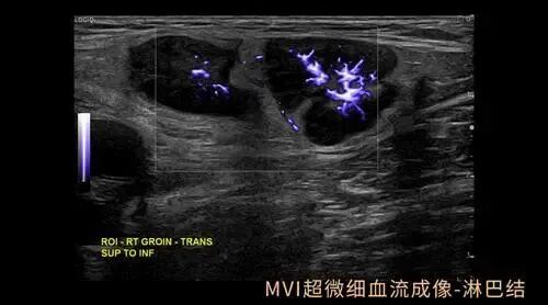 彩超logiq怎么读【重磅消息】更清晰！更高效！更多功能！我院引进GE LOGIQ-Fortis Plus彩超设备_https://www.jmylbn.com_新闻资讯_第3张
