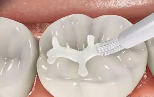 嵌体王者归来补牙新材料不需再做套