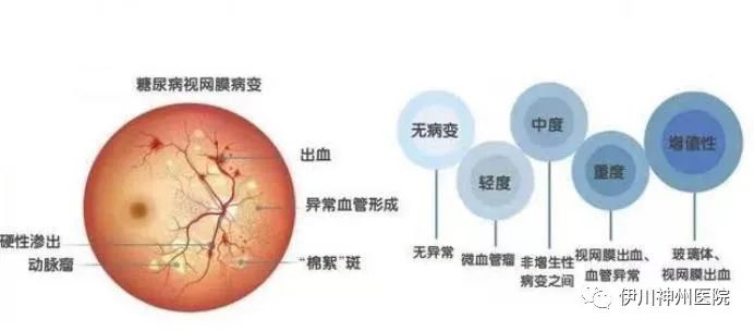 糖尿病视网膜病变健康科普知识