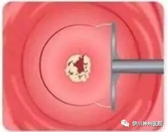 妇科leep刀怎么用LEEP刀科普知识_https://www.jmylbn.com_新闻资讯_第6张