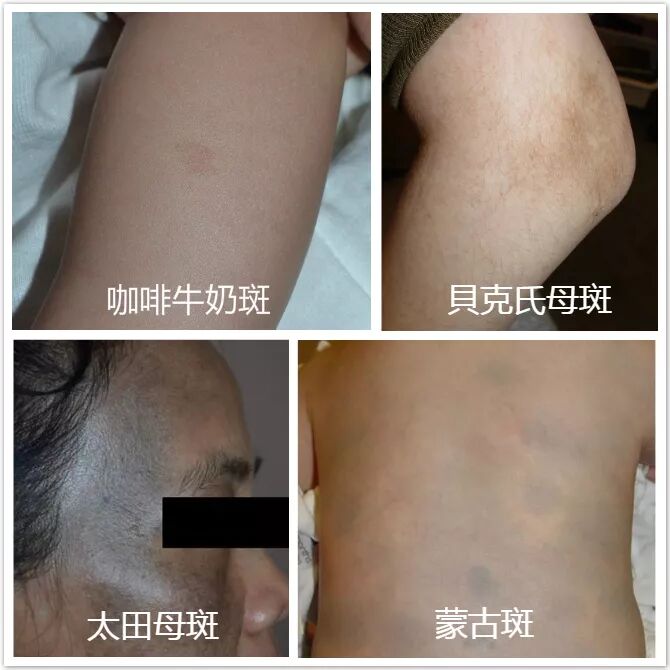 皮秒祛斑無效又反黑 您get到祛斑的重點了嗎 Uhkhealth 微信公众号文章阅读 Wemp