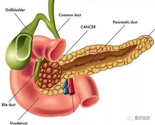 胰腺肿瘤能活多久，这种癌症从早期发展到晚期要多长时间
