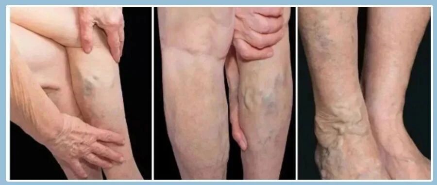 静脉曲张会导致截肢？！这种常见病，千万别轻视，用它抹一抹，预防静脉曲张