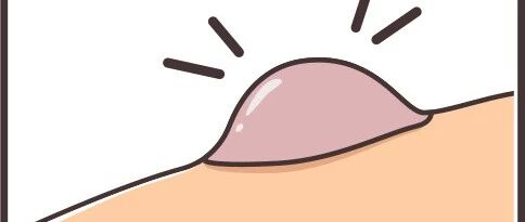 你身上的黑痣会不会是“定时炸弹”？首先要区分这六点！