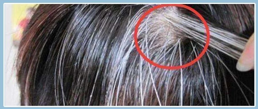 白发越长越多，原来是这里出了问题！再不重视，就不只是白头了!