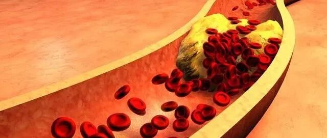 血管里有斑块的6个迹象，及时治疗，能救你的命！
