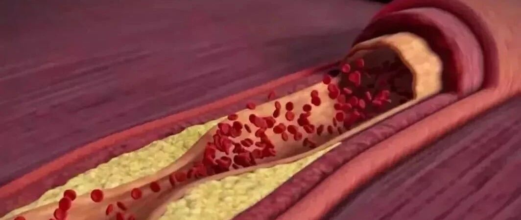 血液瘀堵怎么办？每天吃点它，降脂溶栓护血管，太有用了！