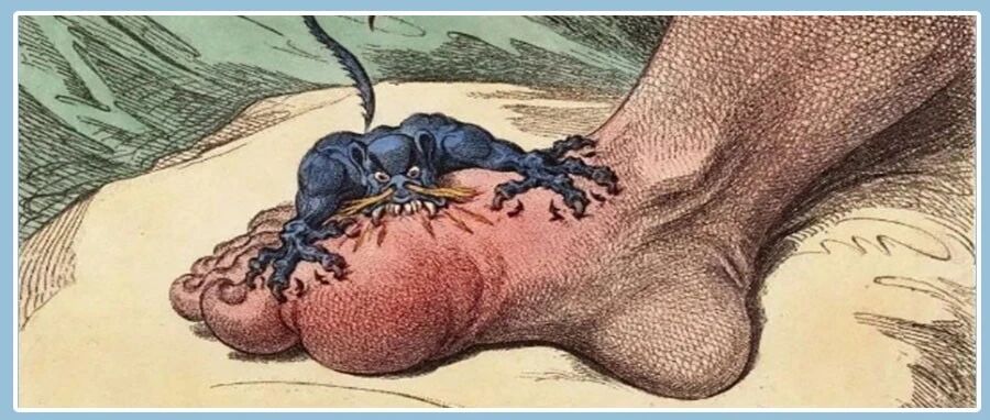 痛风发作生不如死，一个中药小方子帮你缓解