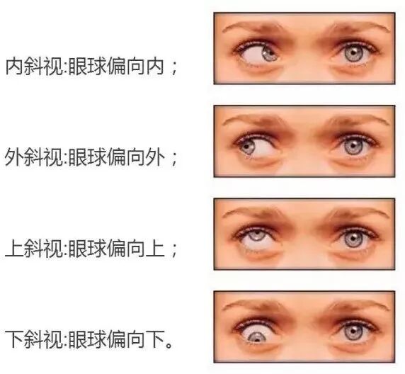 常见的斜视症状如何治疗斜视?