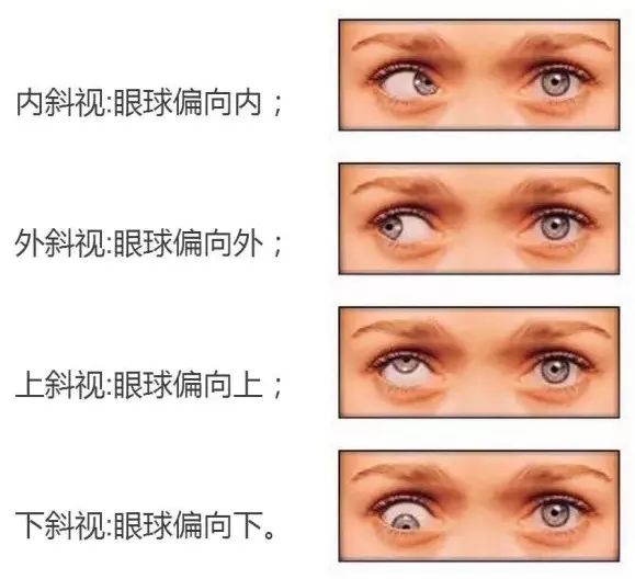 斜视|【提醒】3岁萌娃总是“歪头杀”，看起来萌萌哒，一查竟是…