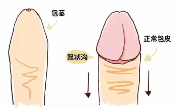 春节包皮指南 | 主动割包皮,是一个男生成熟的标志!(图1) 图片