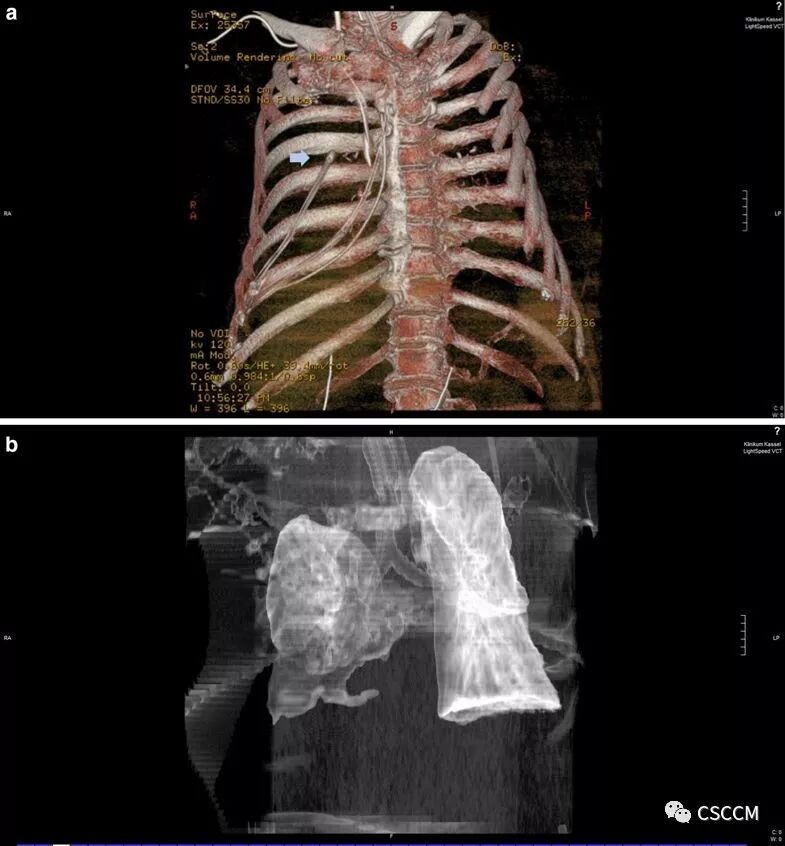 怎么拔鼻腔引流管胃管术（二）_https://www.jmylbn.com_新闻资讯_第6张