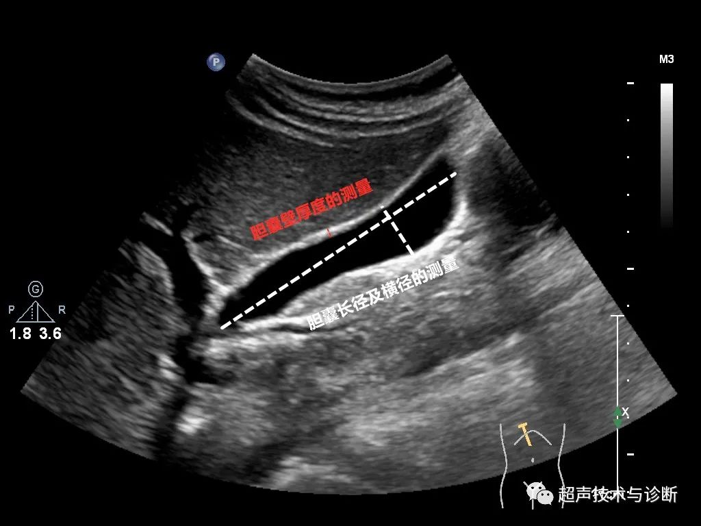 测胆道压力怎么测胆道系统超声测量及正常参考值_https://www.jmylbn.com_新闻资讯_第3张