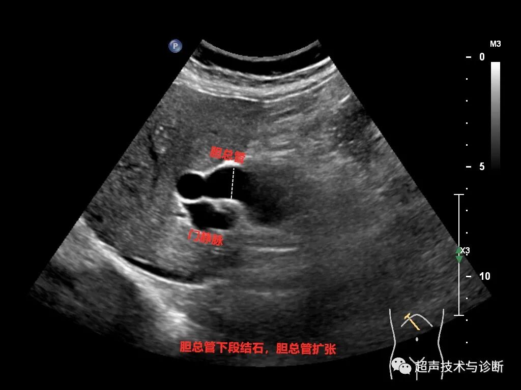测胆道压力怎么测胆道系统超声测量及正常参考值_https://www.jmylbn.com_新闻资讯_第4张
